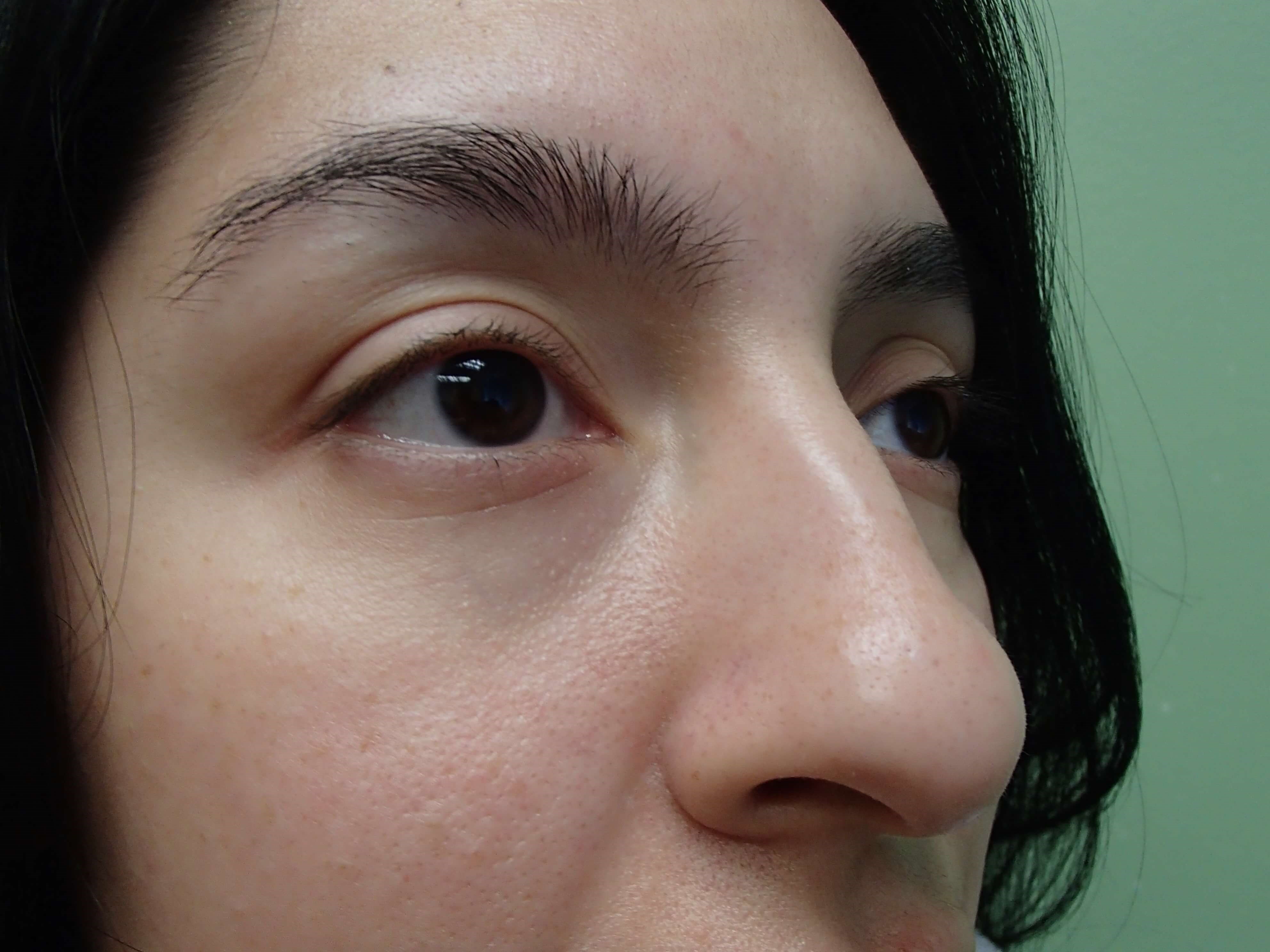 Rhinoplasty w/ Septoplasty Before
