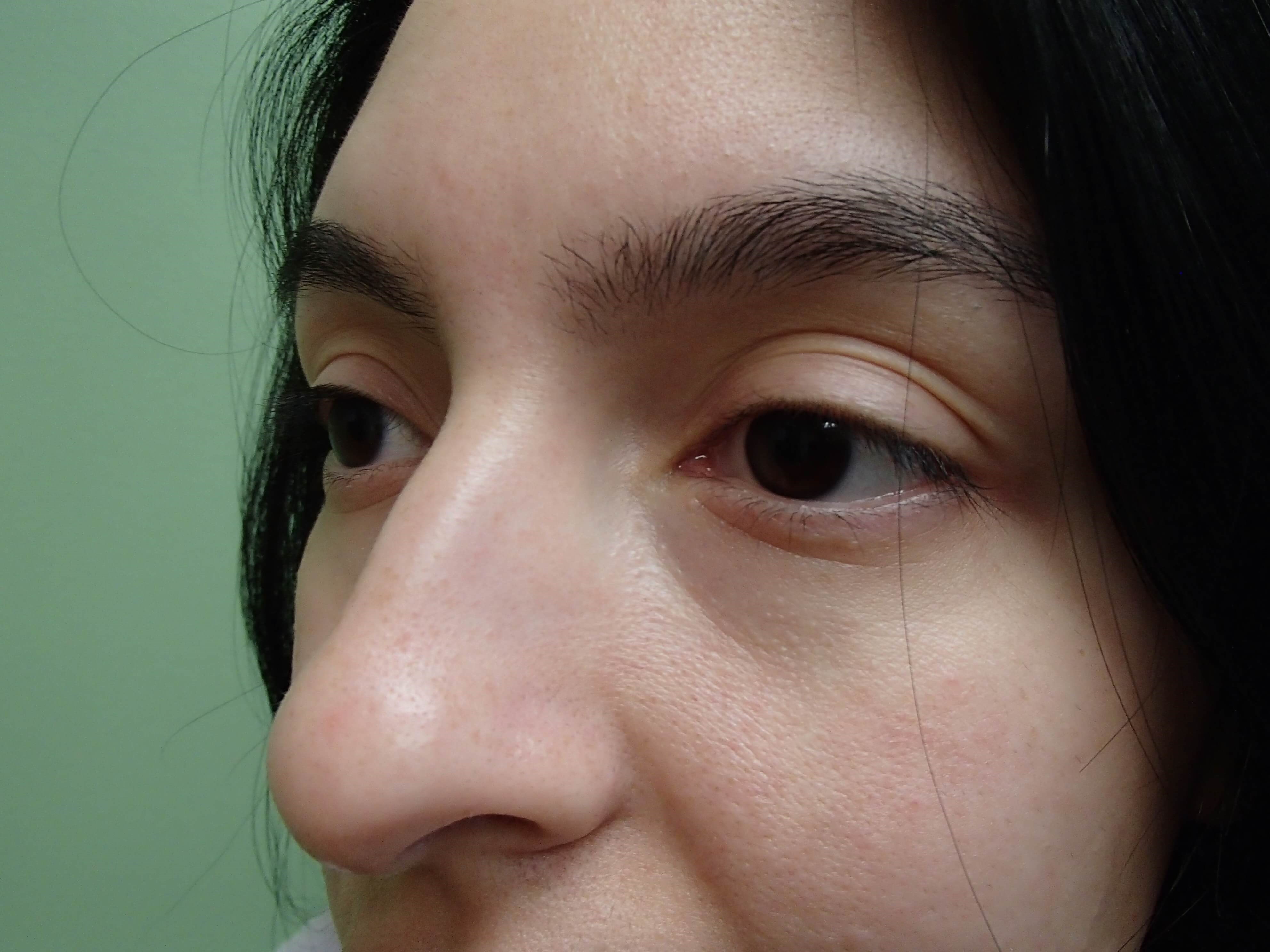 Rhinoplasty w/ Septoplasty Before