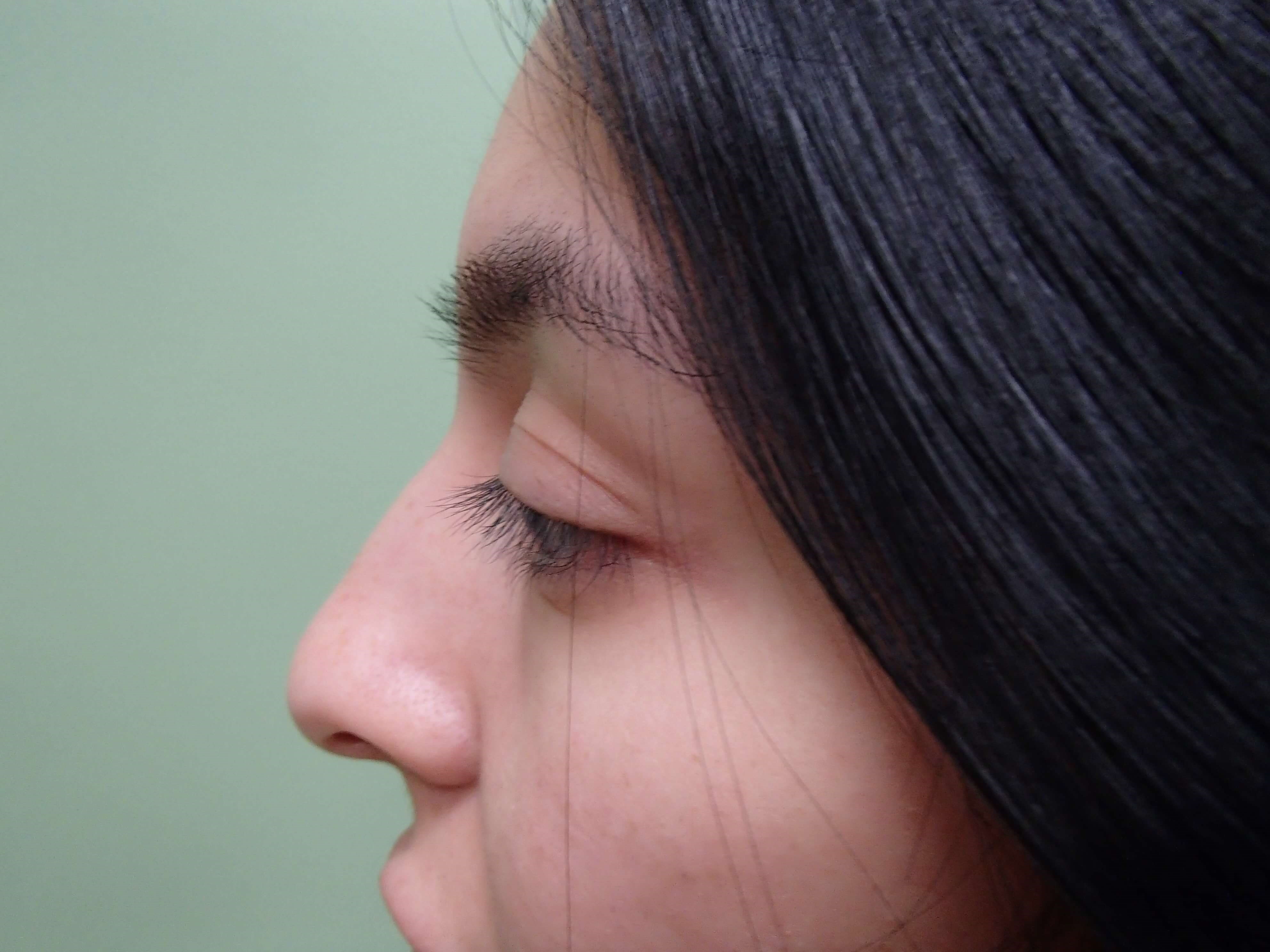 Rhinoplasty w/ Septoplasty Before