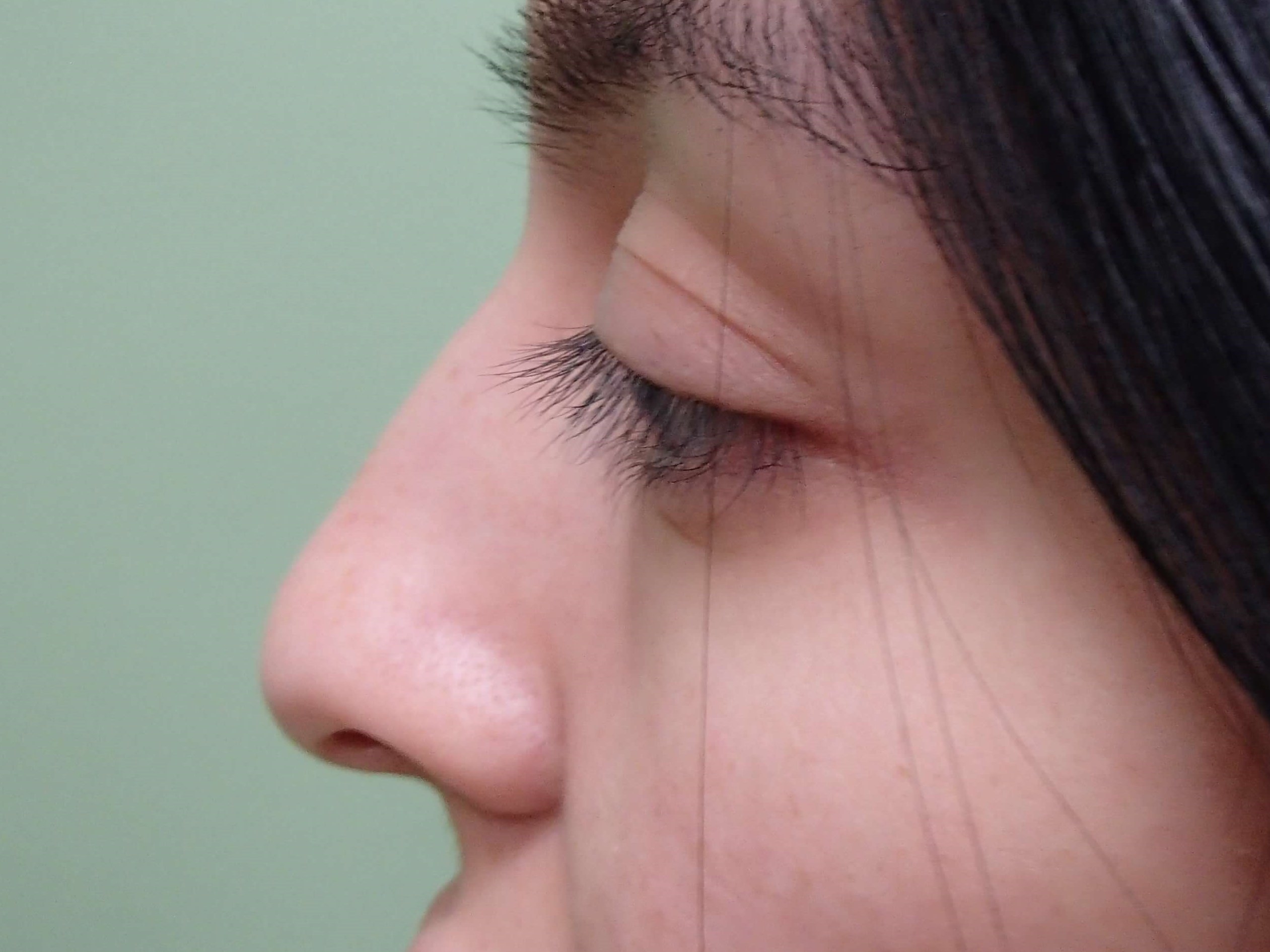 Rhinoplasty w/ Septoplasty Before