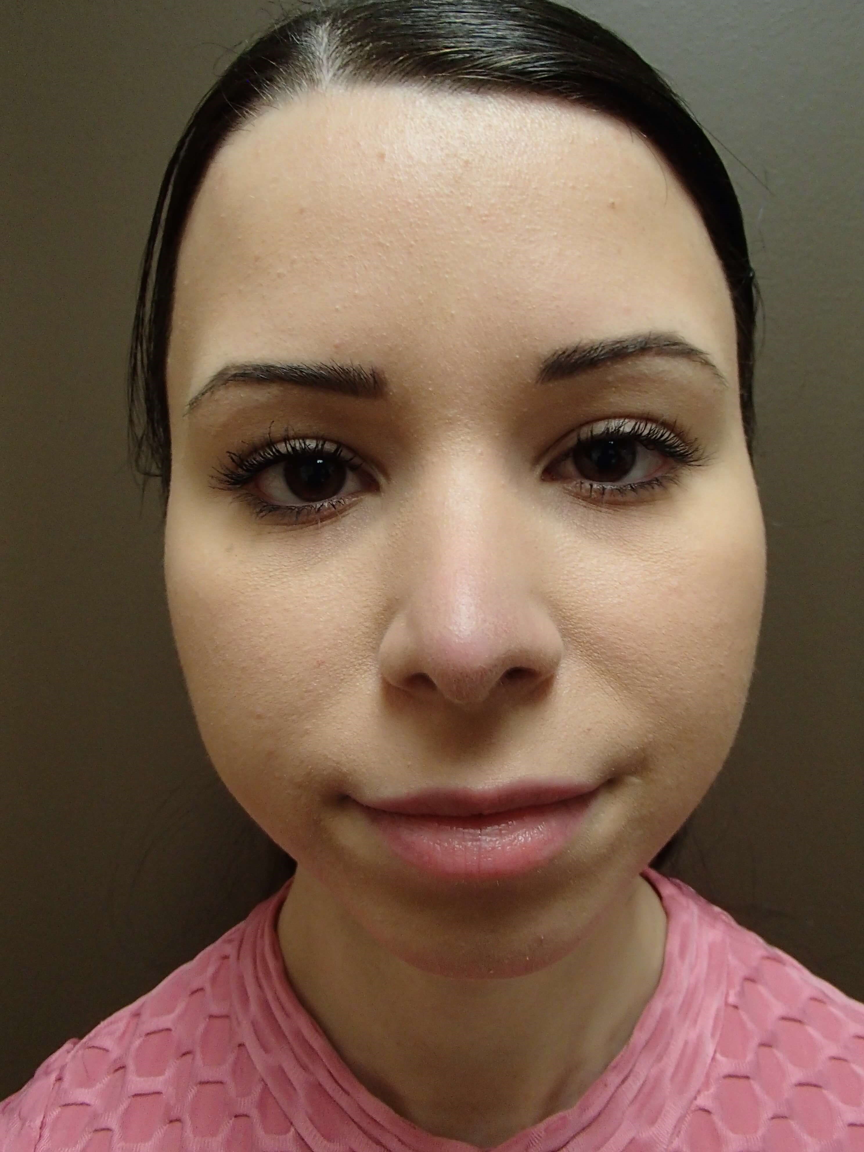 Rhinoplasty After