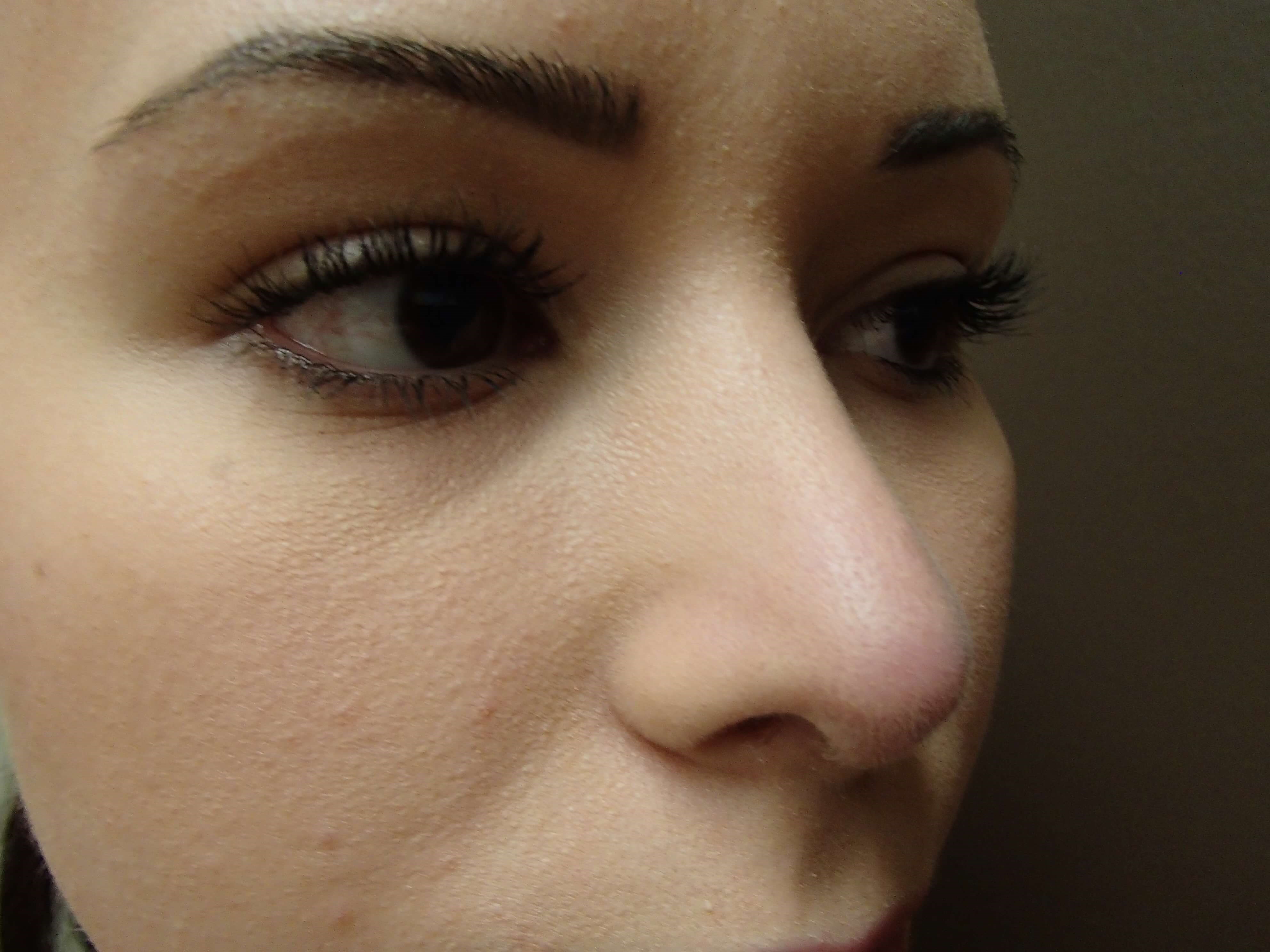 Rhinoplasty After