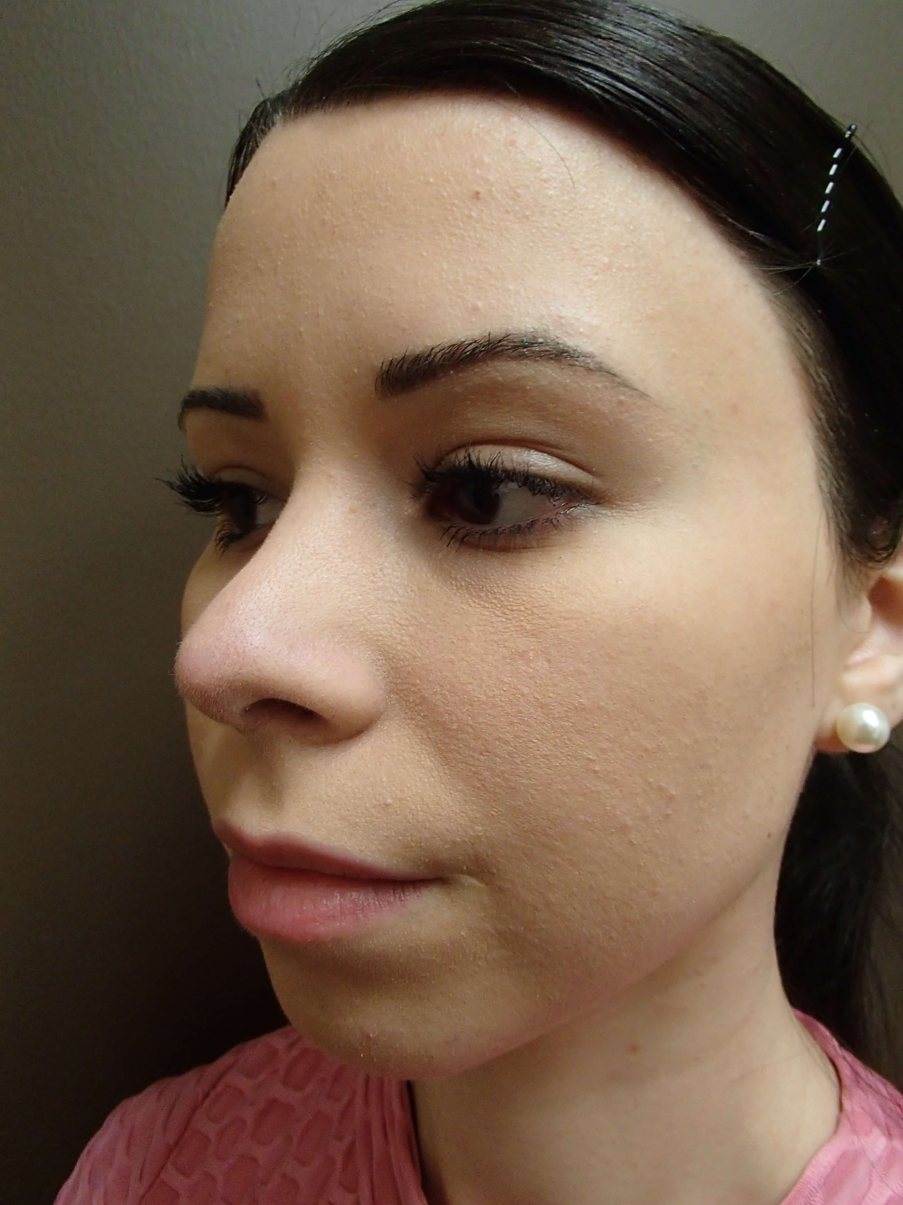 Rhinoplasty After
