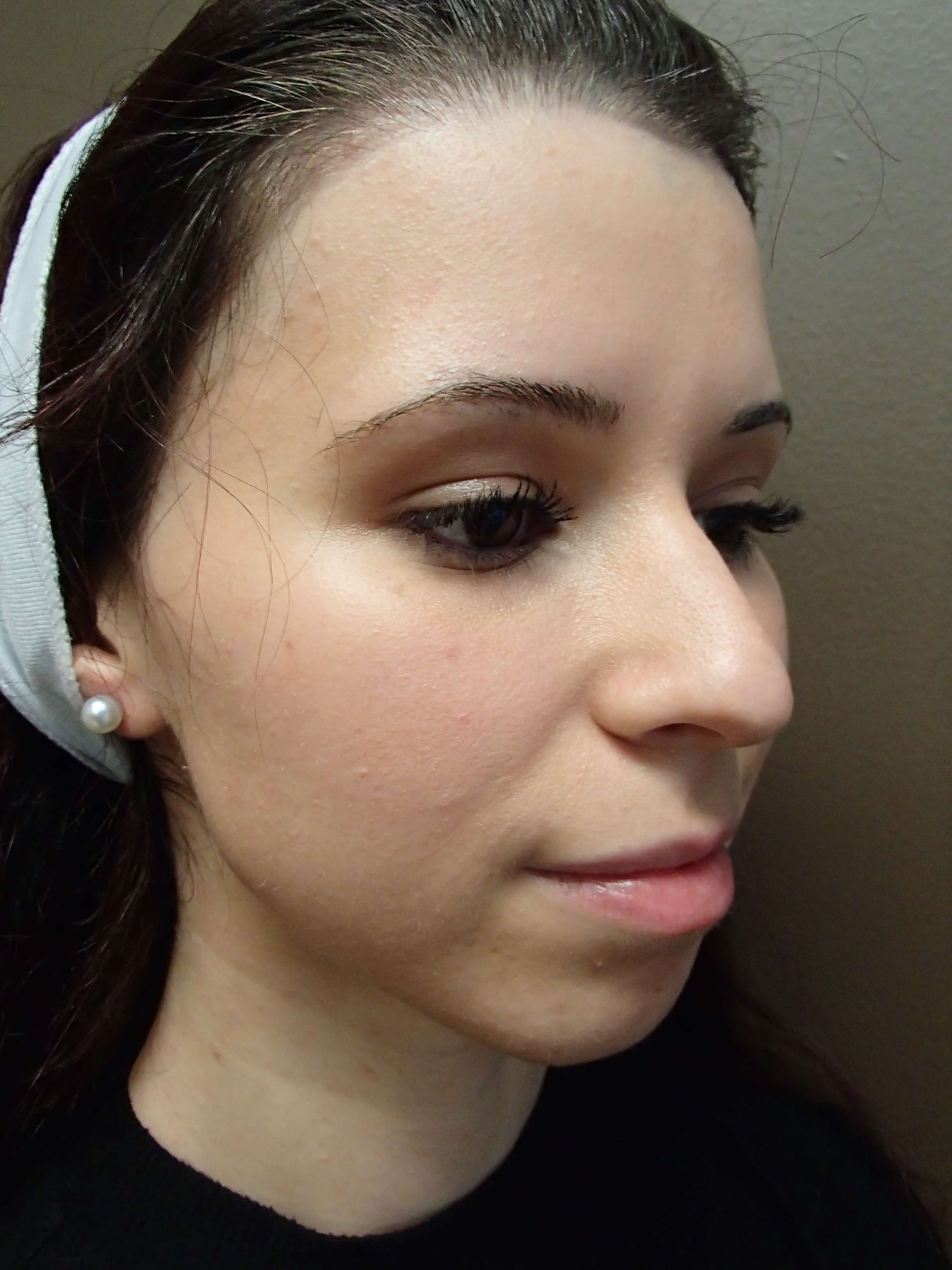 Rhinoplasty Before