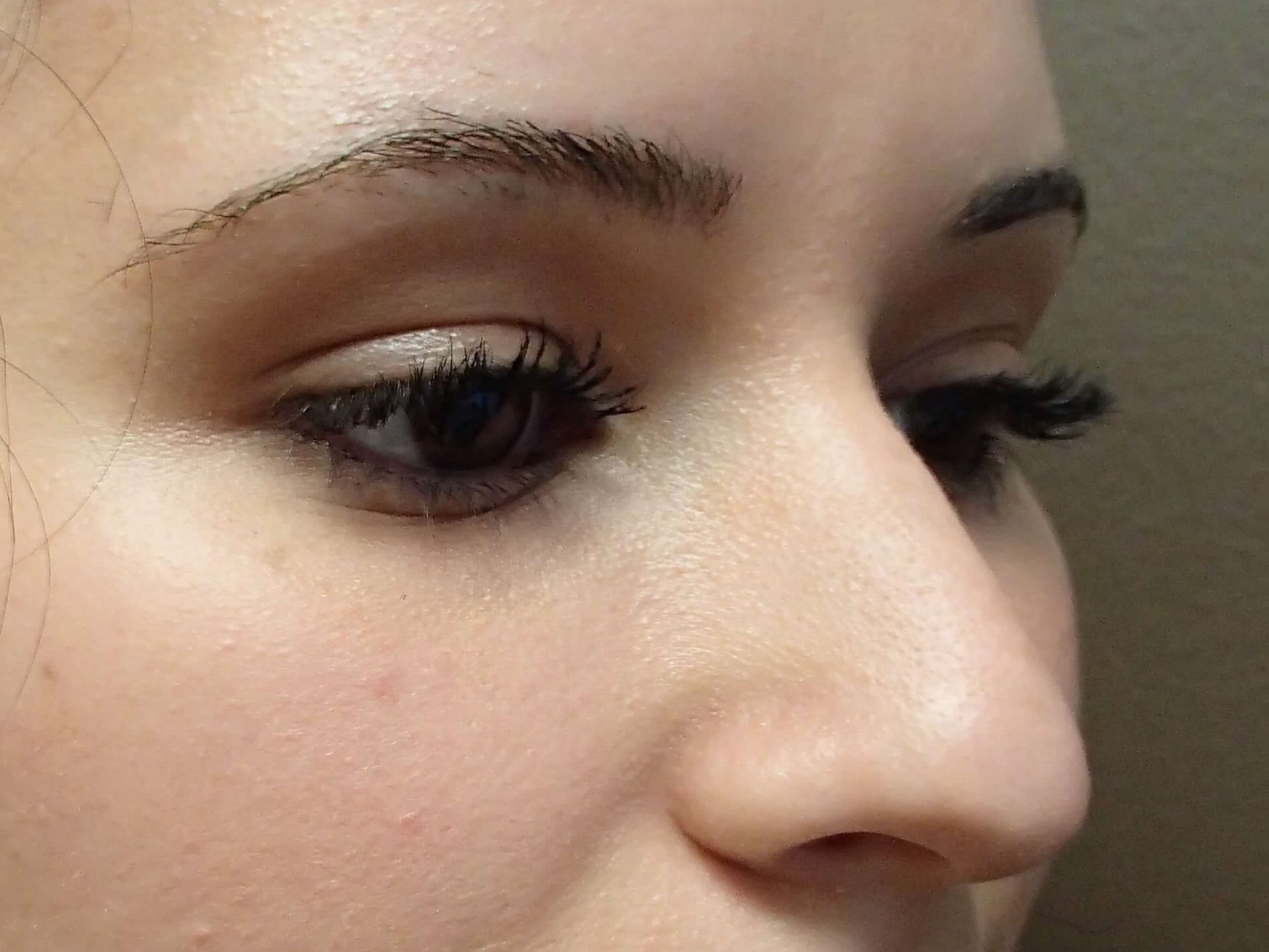 Rhinoplasty Before
