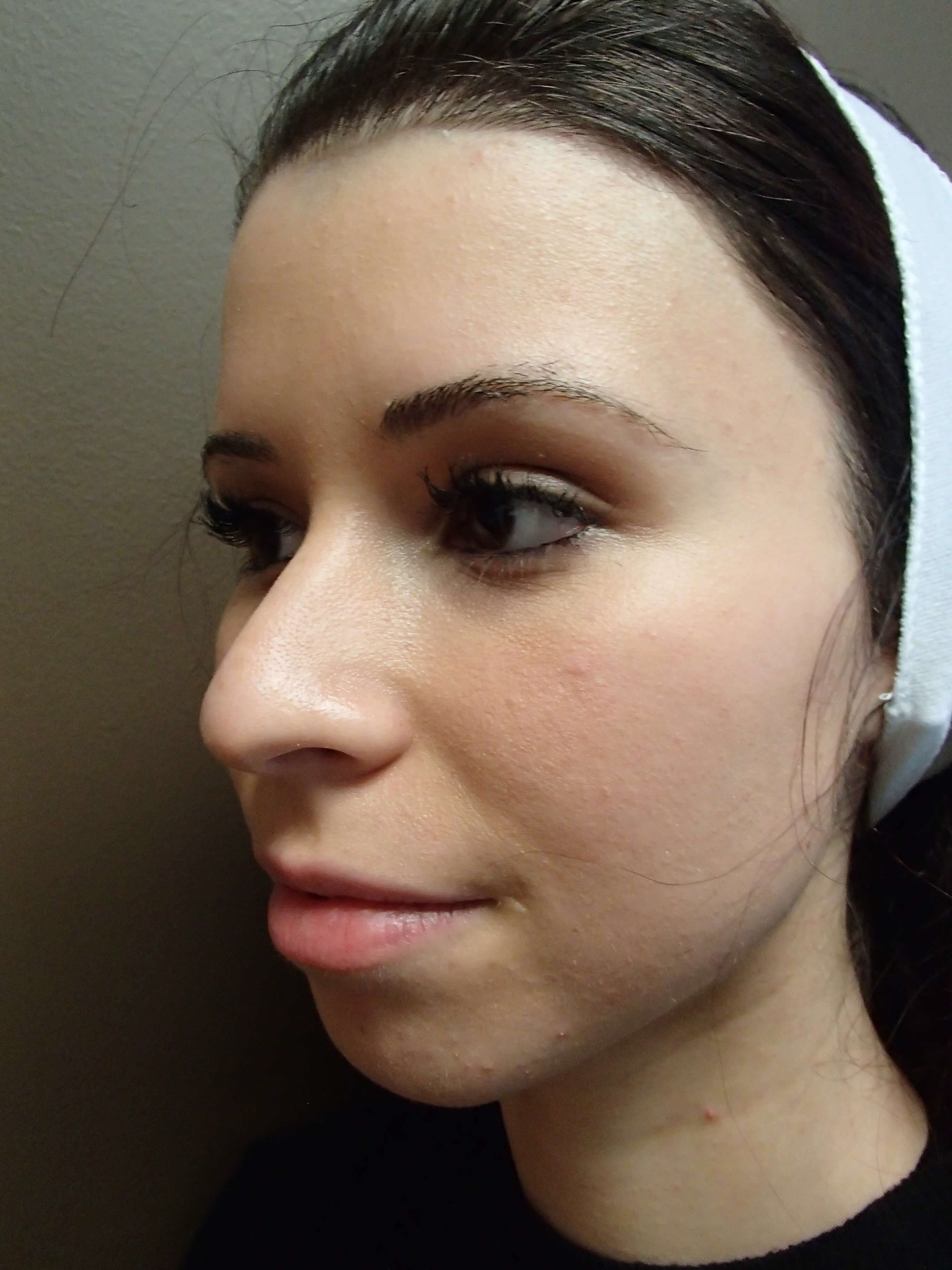 Rhinoplasty Before