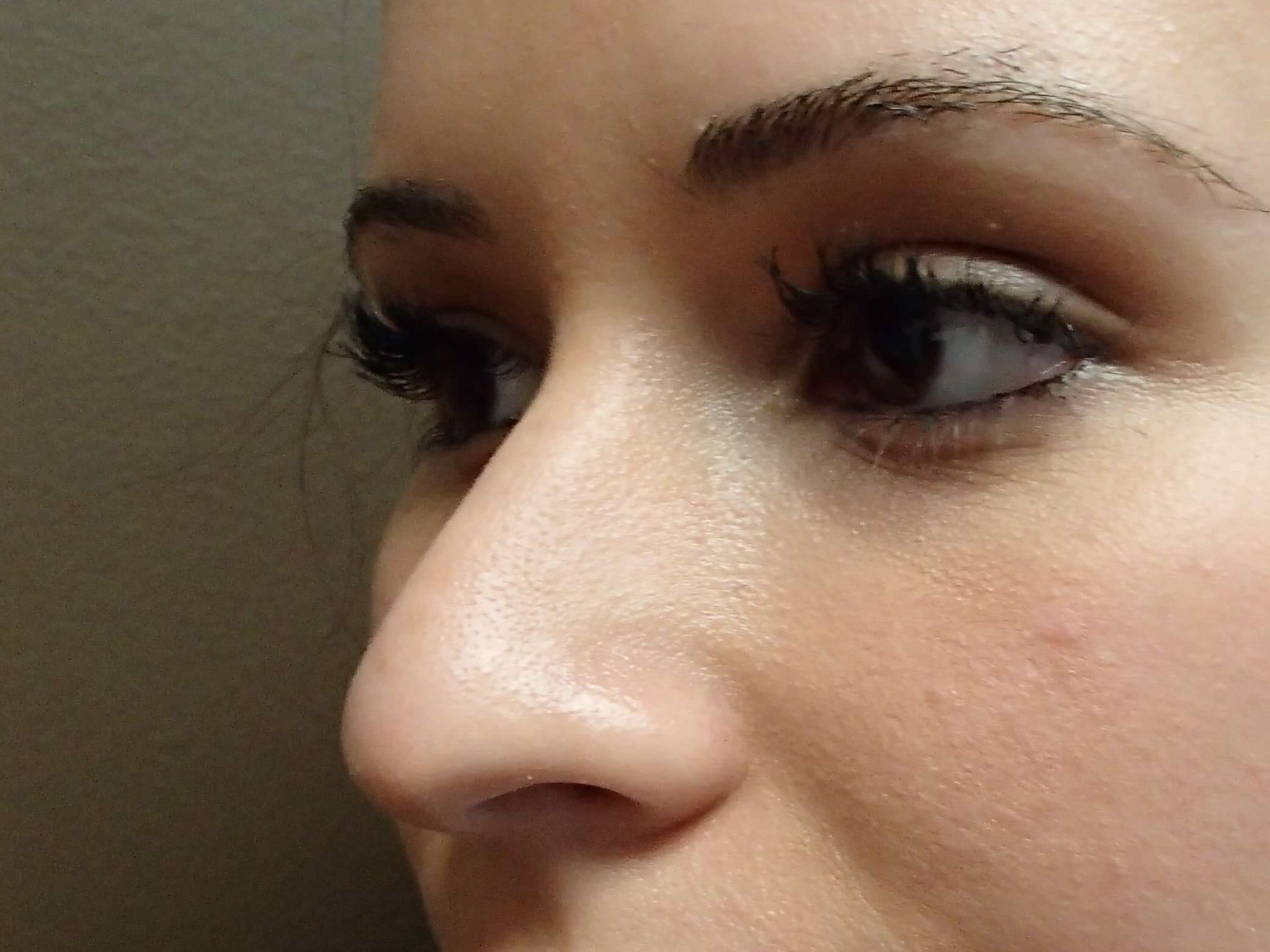 Rhinoplasty Before