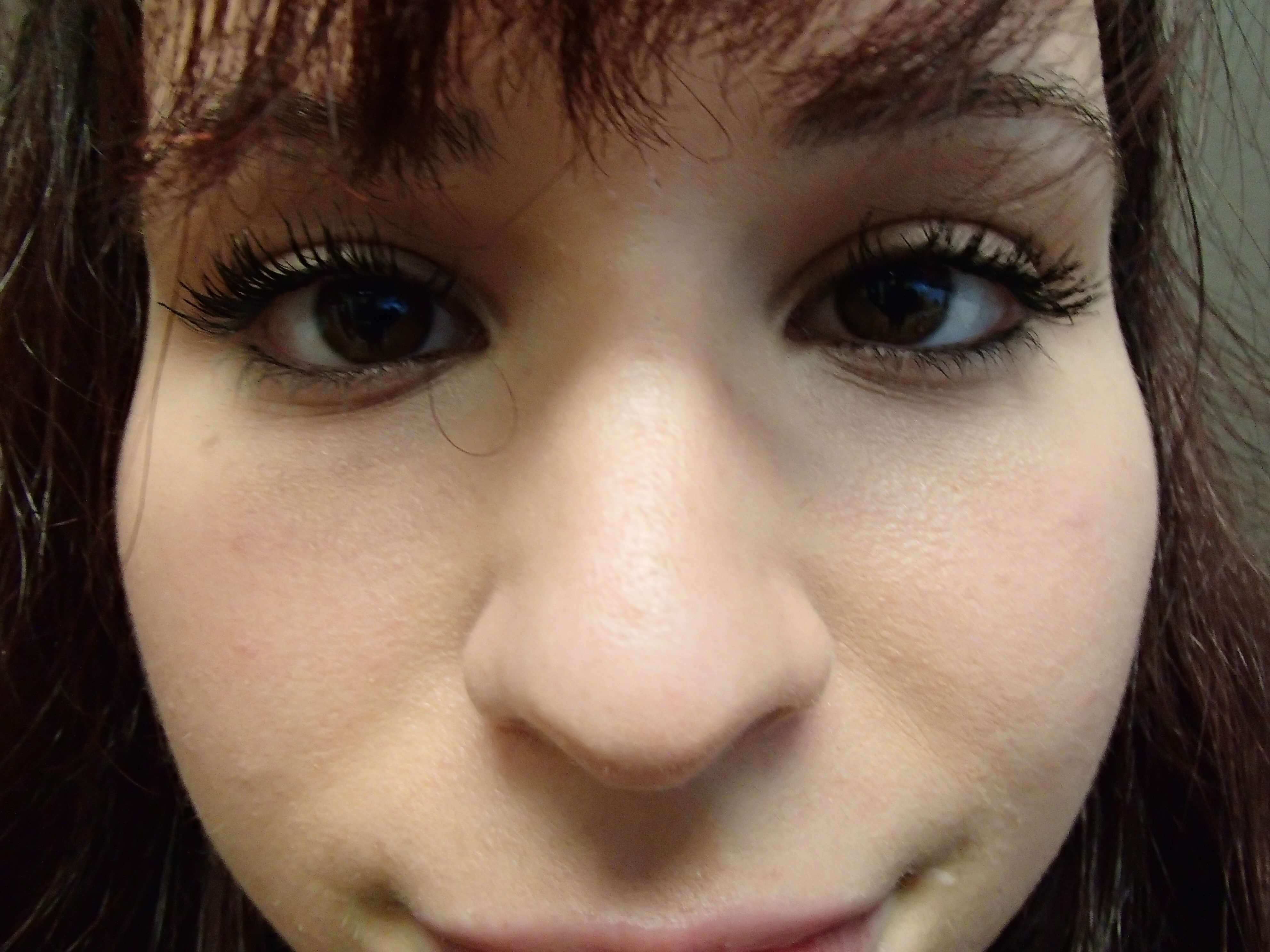 Rhinoplasty Before