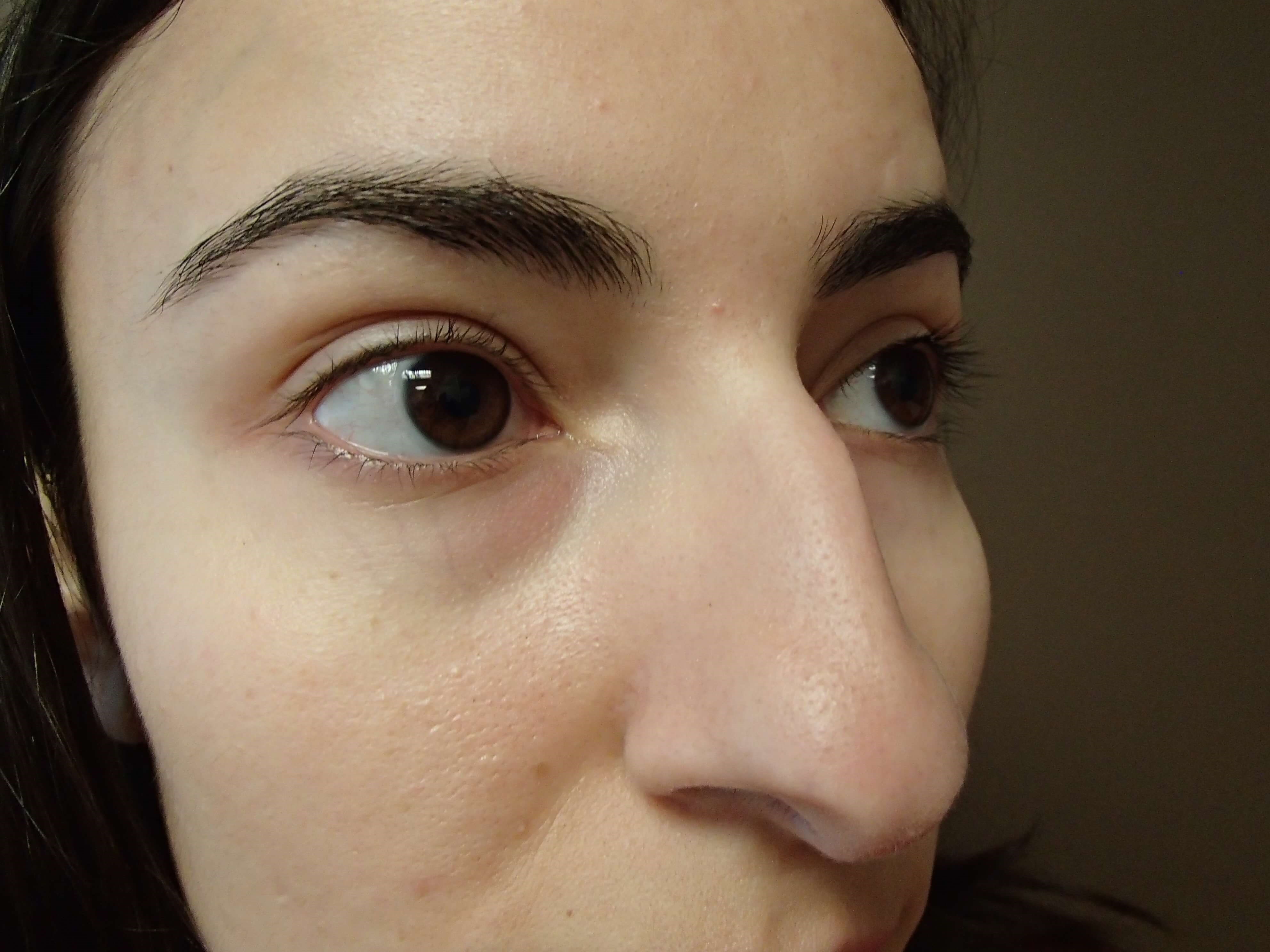Rhinoplasty Before