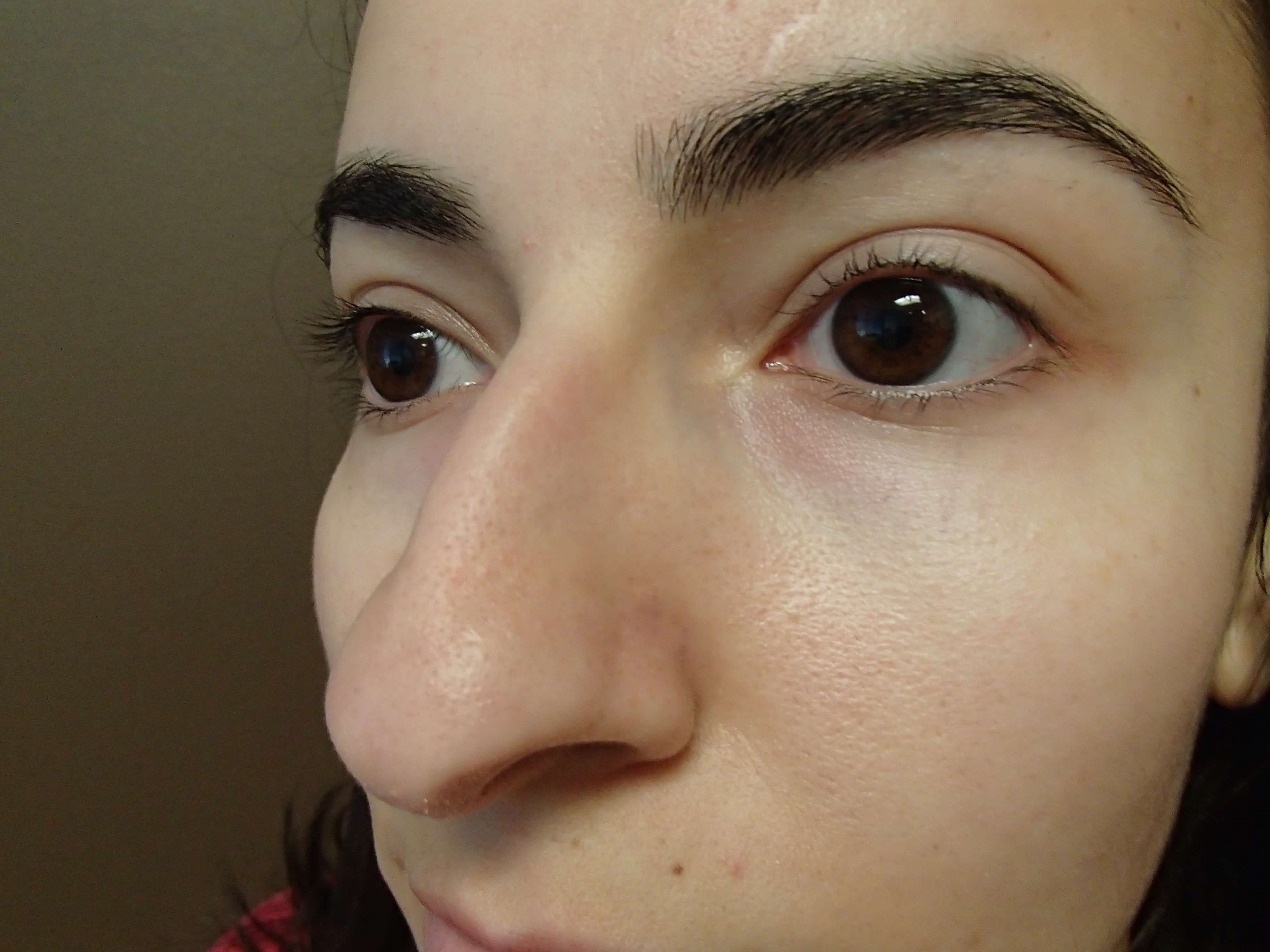 Rhinoplasty Before
