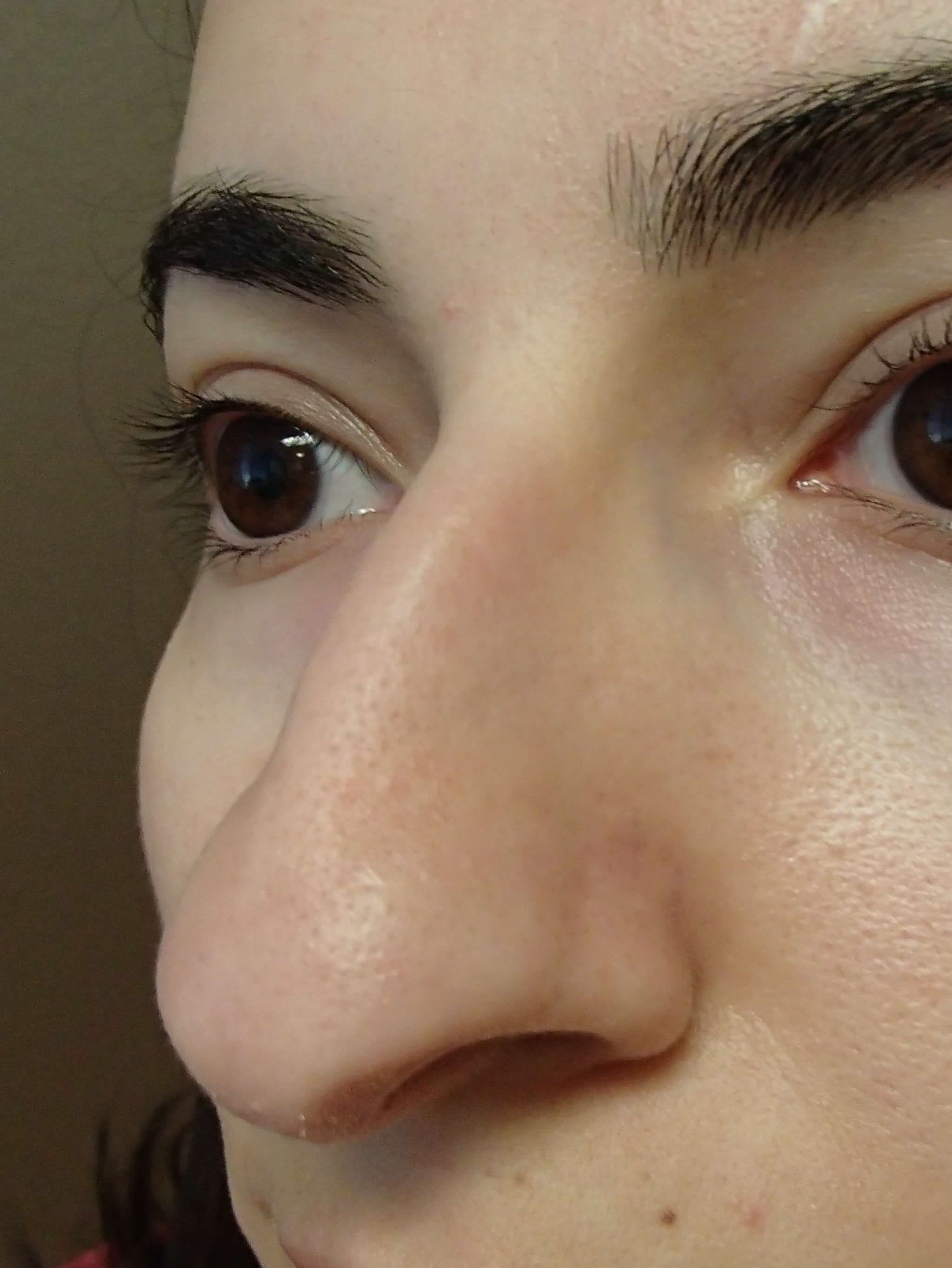Rhinoplasty Before