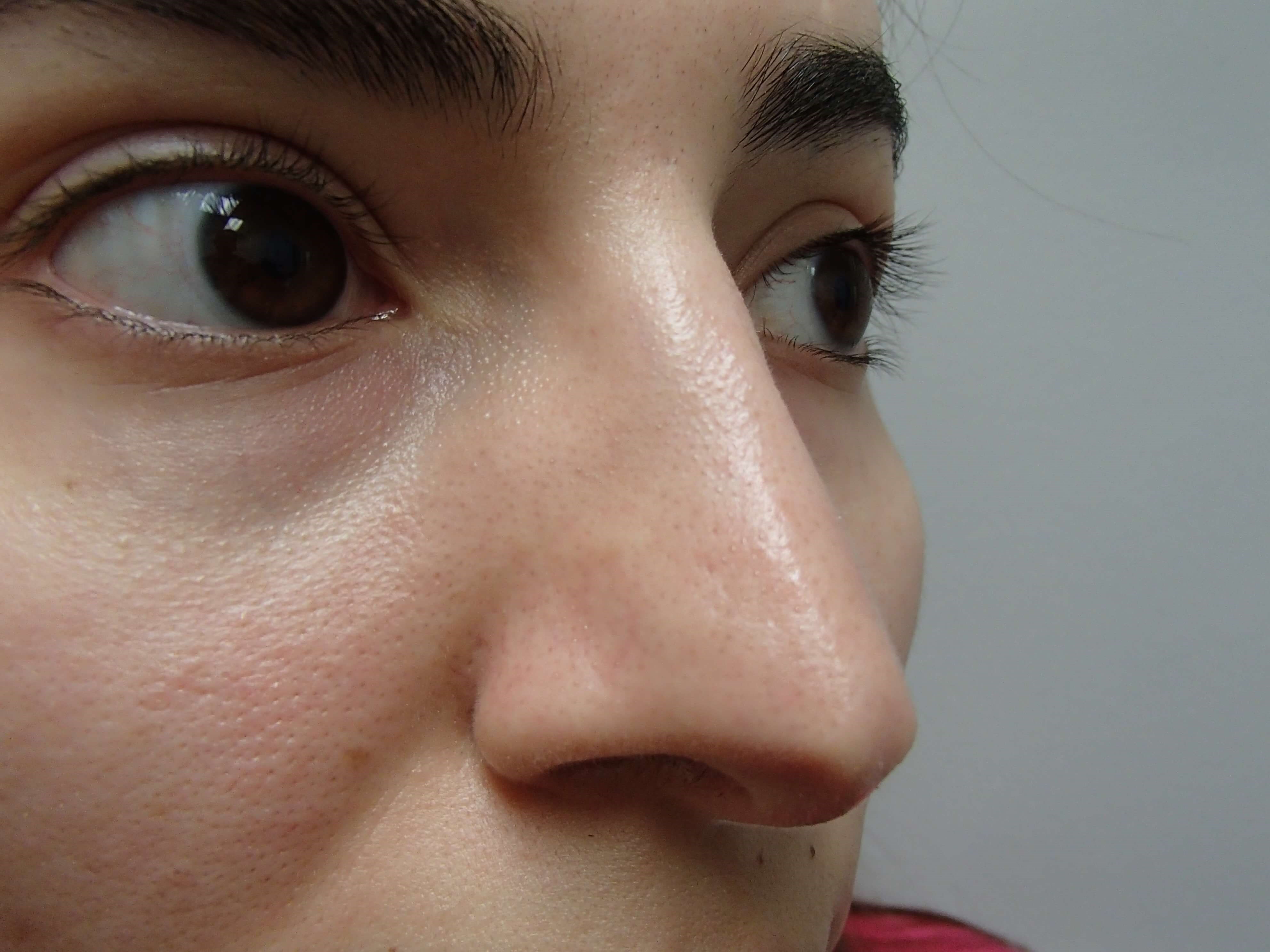 Rhinoplasty After