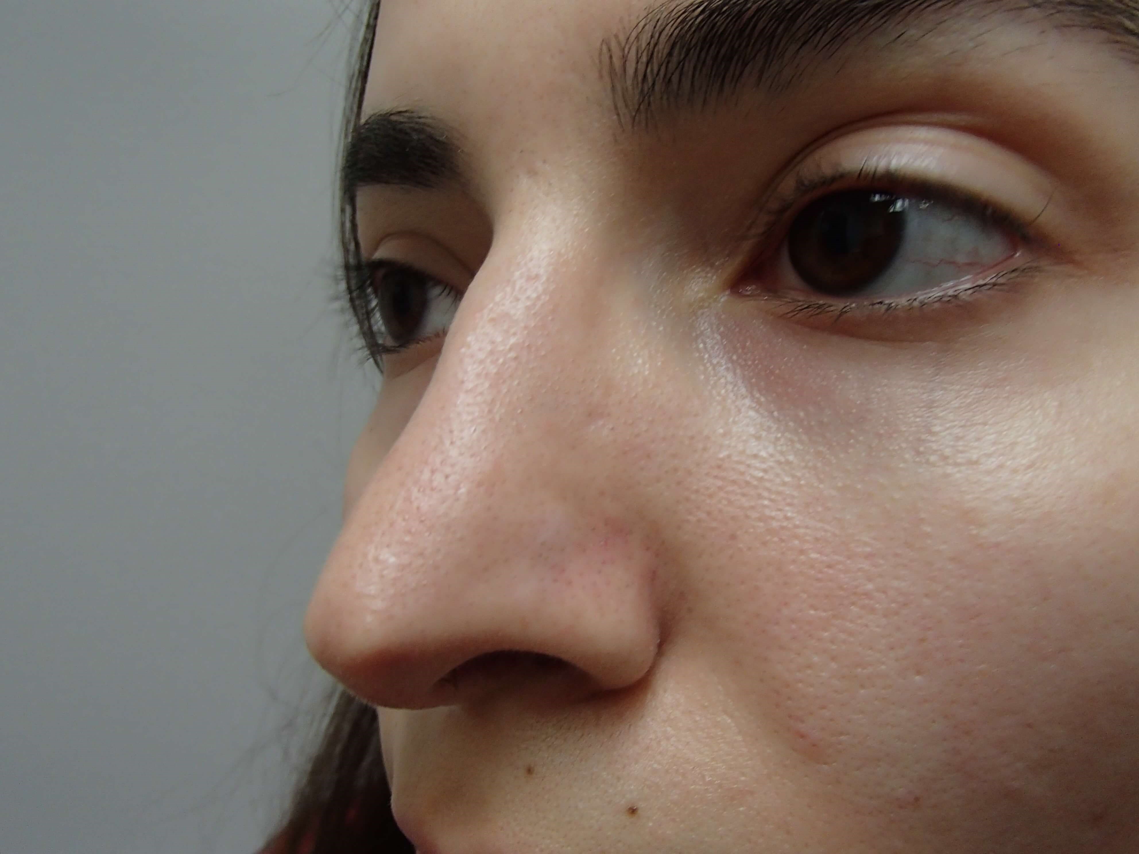 Rhinoplasty After
