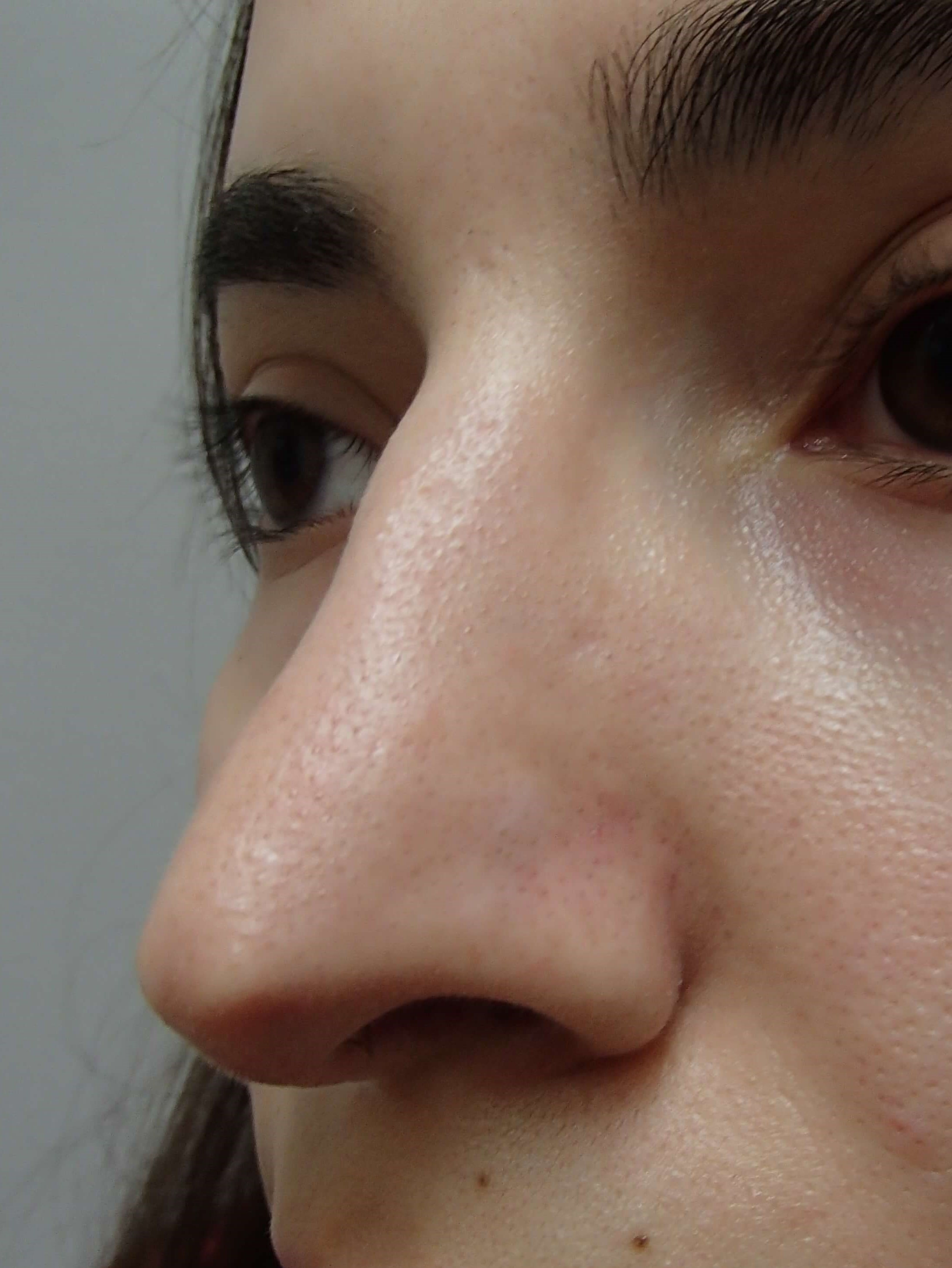 Rhinoplasty After