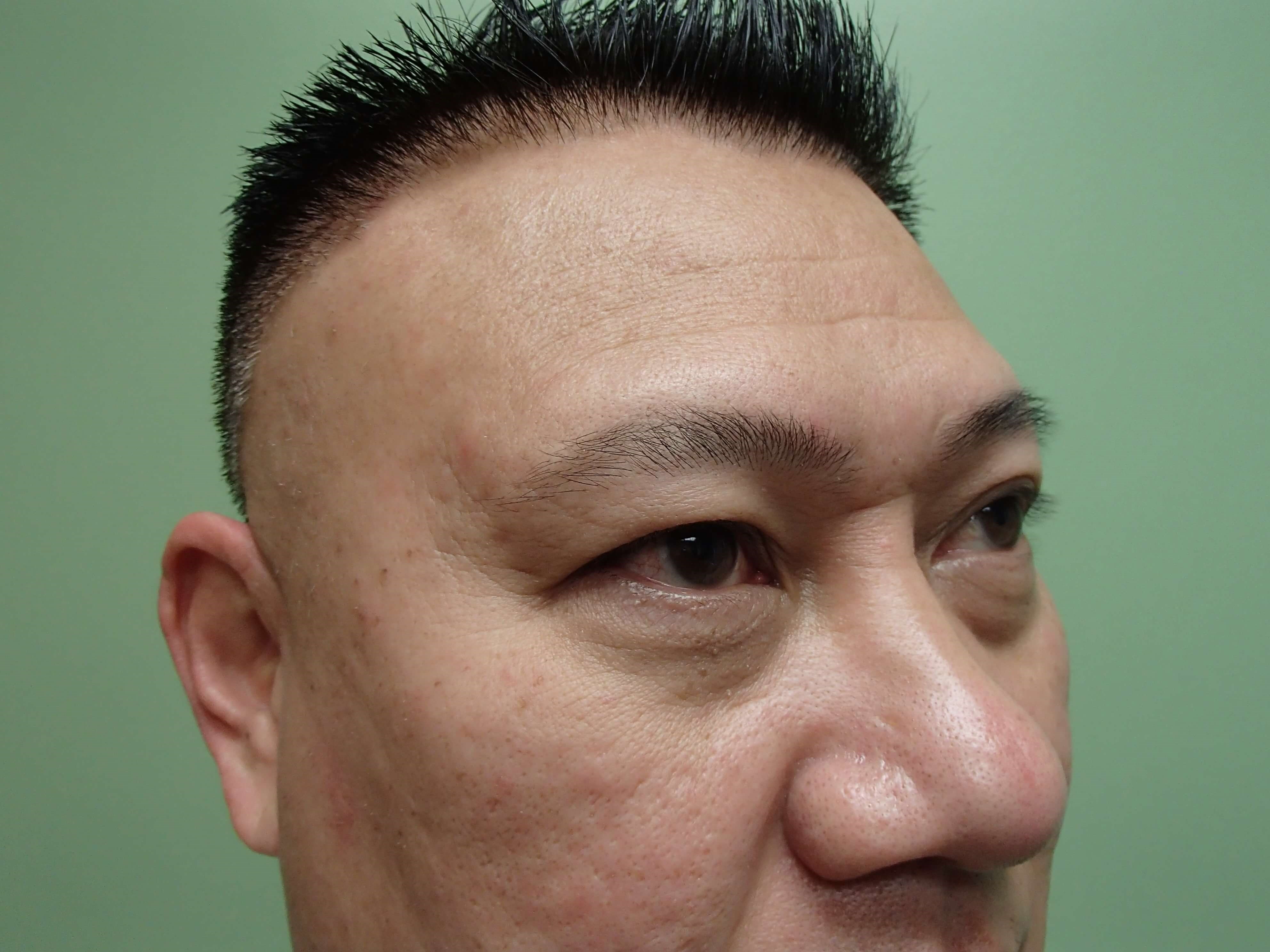 Blepharoplasty w/ Browlift Before