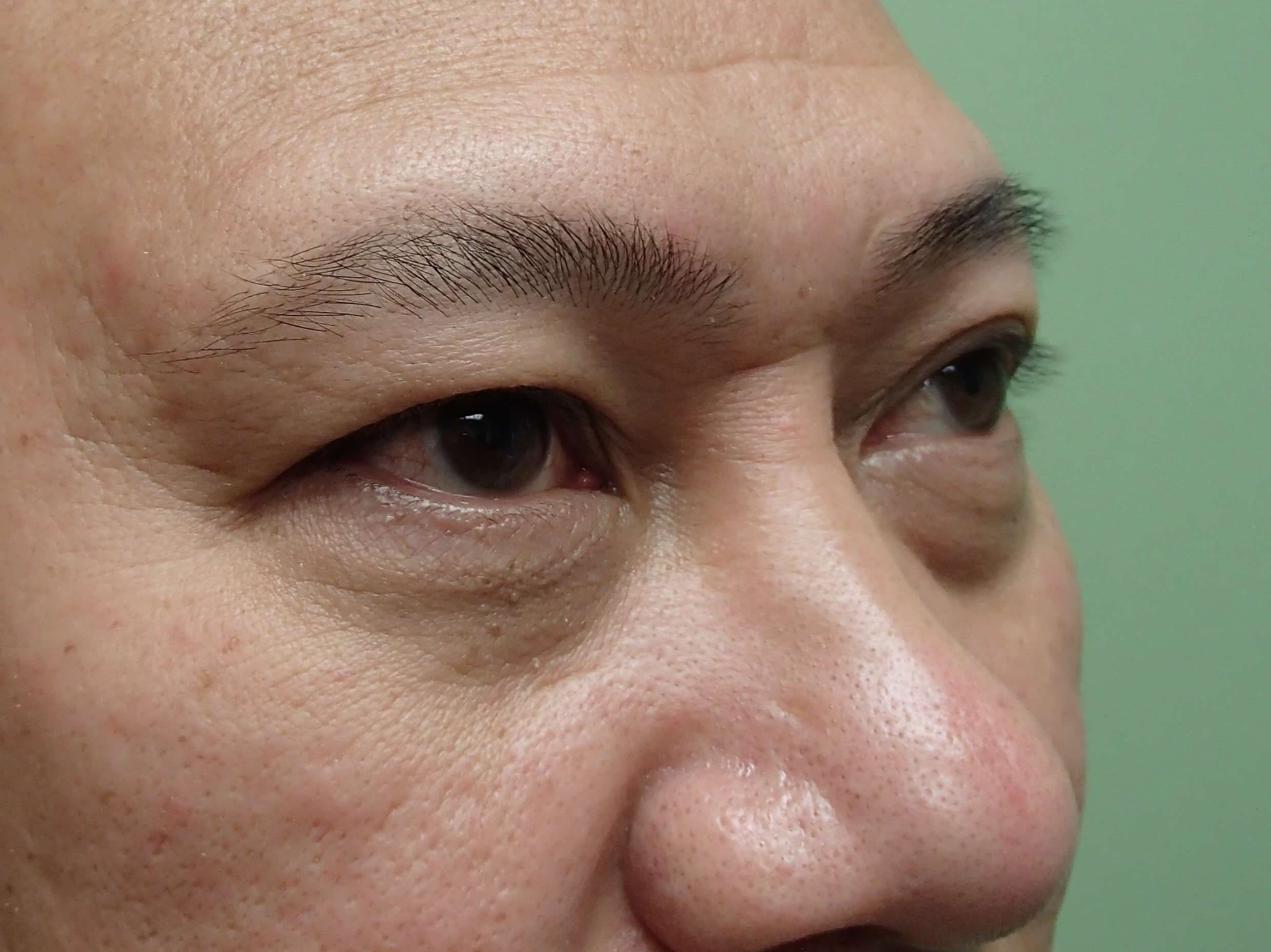 Blepharoplasty w/ Browlift Before