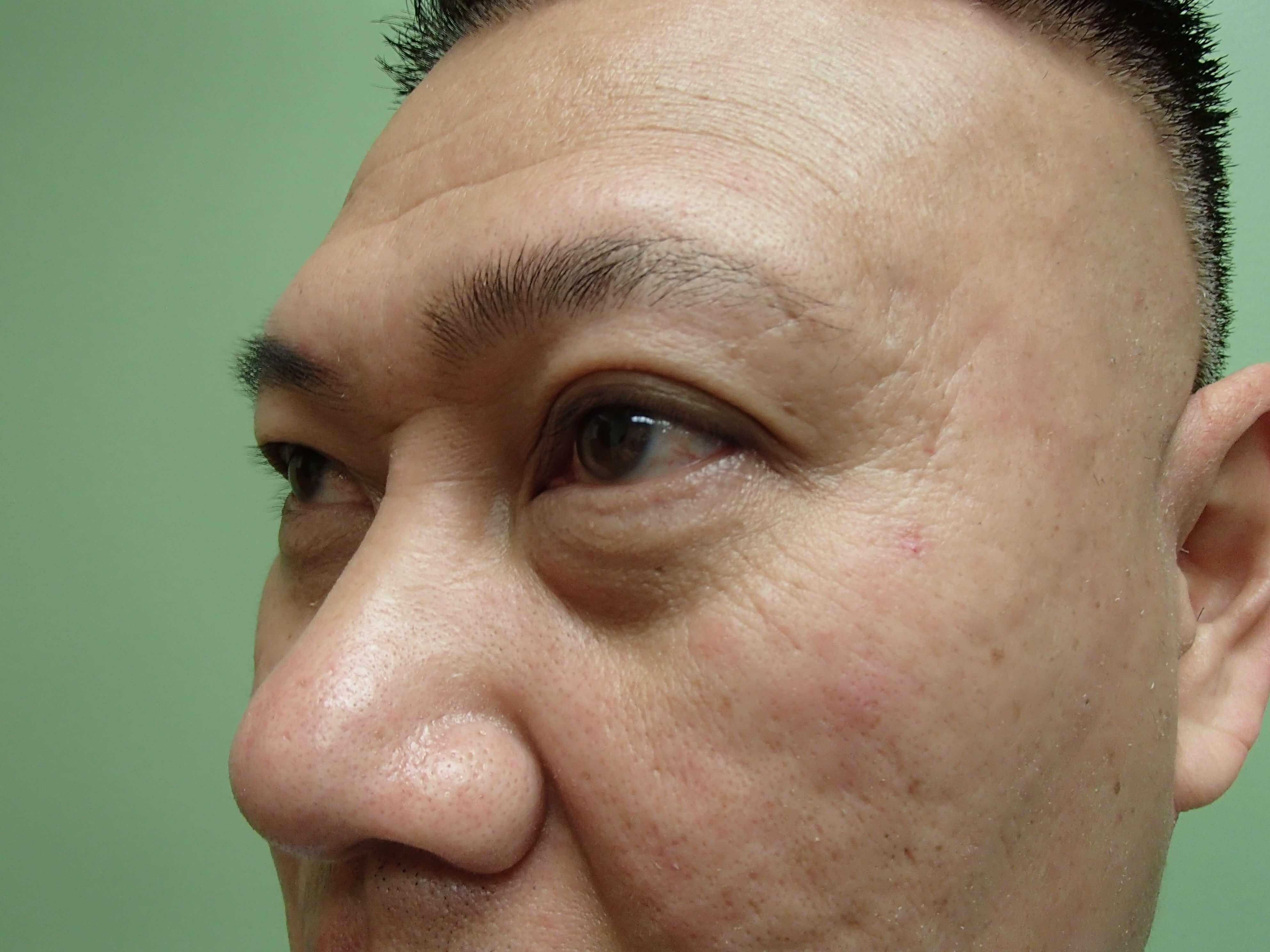 Blepharoplasty w/ Browlift Before