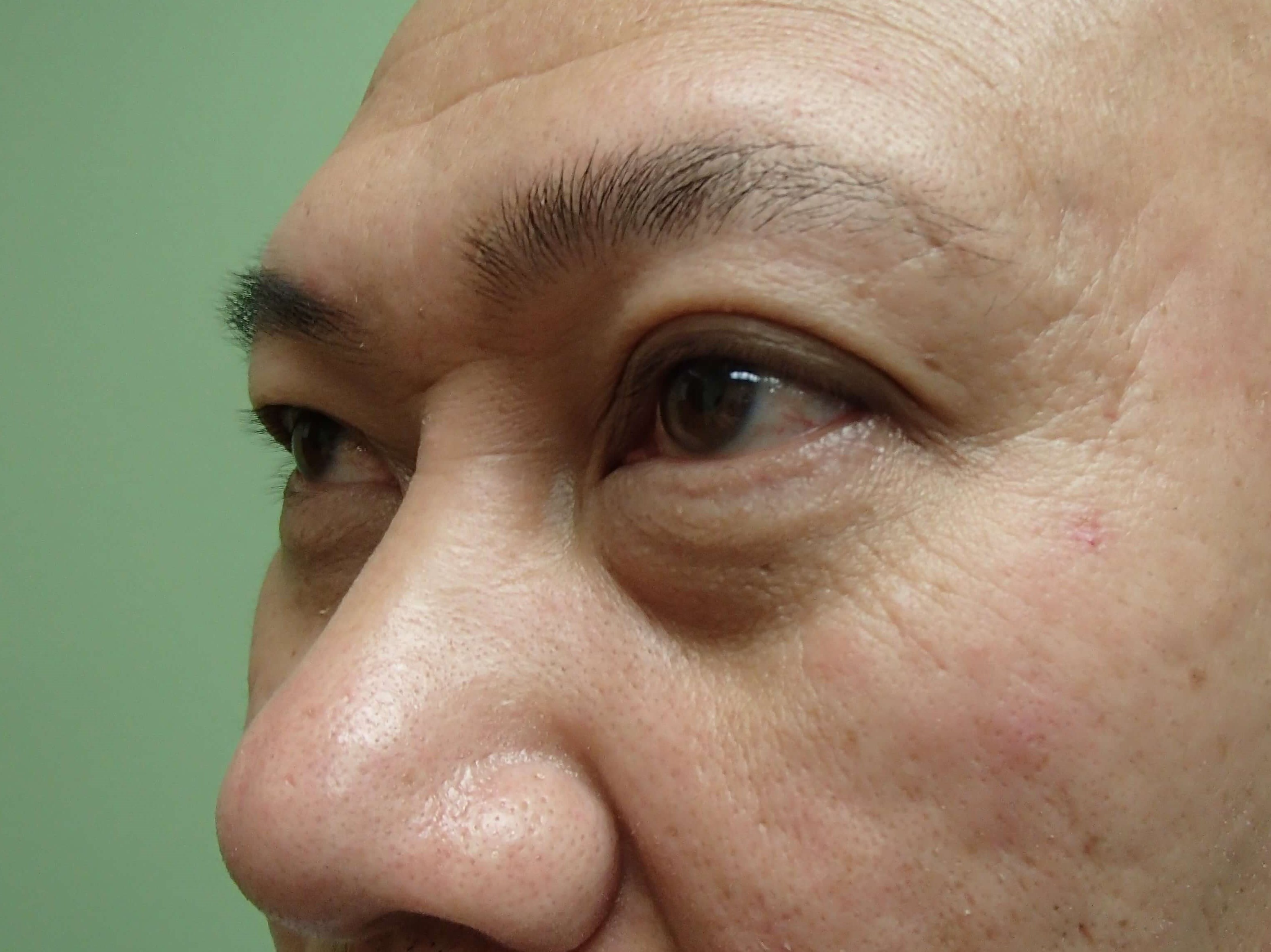 Blepharoplasty w/ Browlift Before