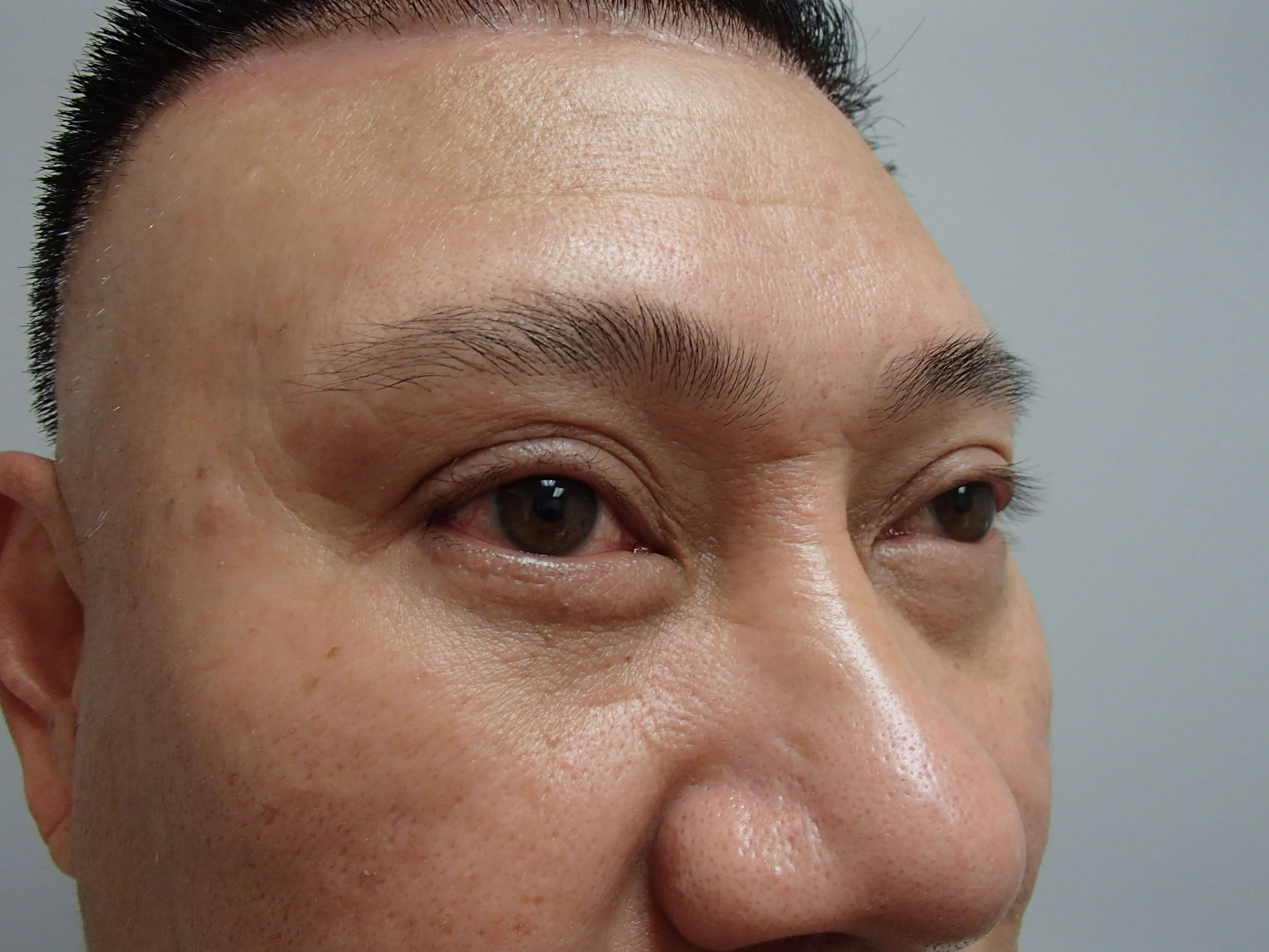 Blepharoplasty w/ Browlift After