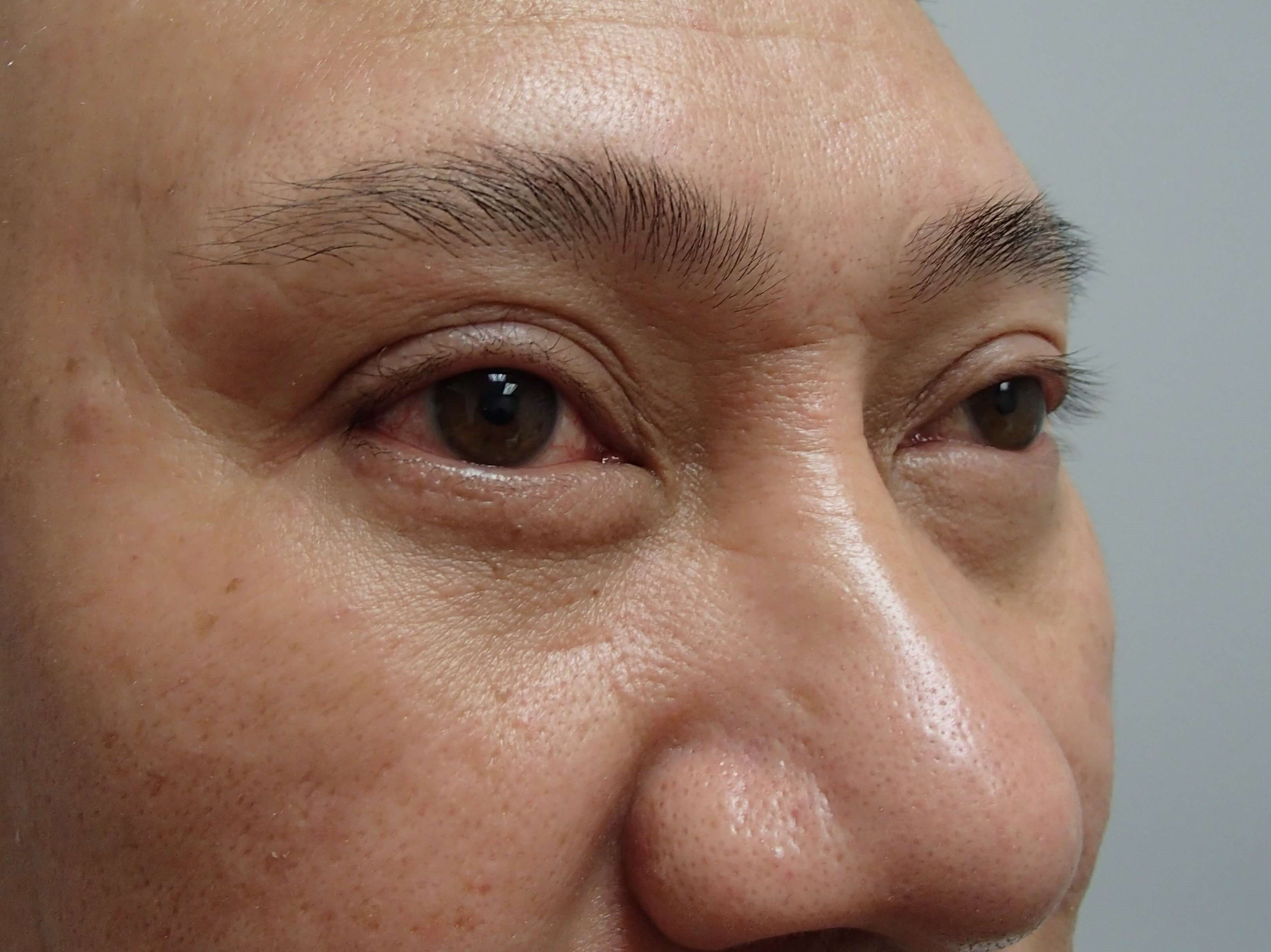Blepharoplasty w/ Browlift After