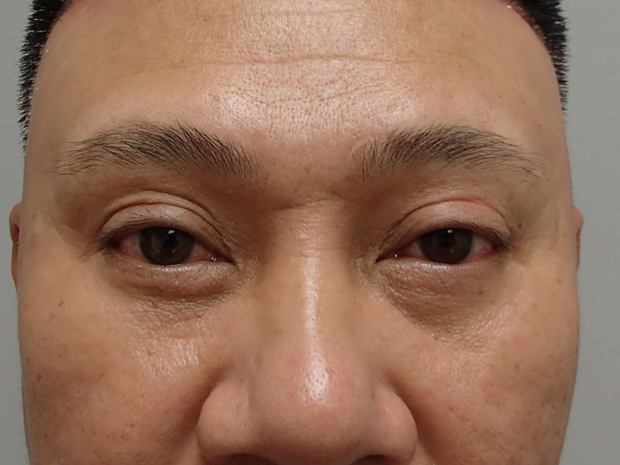 Blepharoplasty w/ Browlift After
