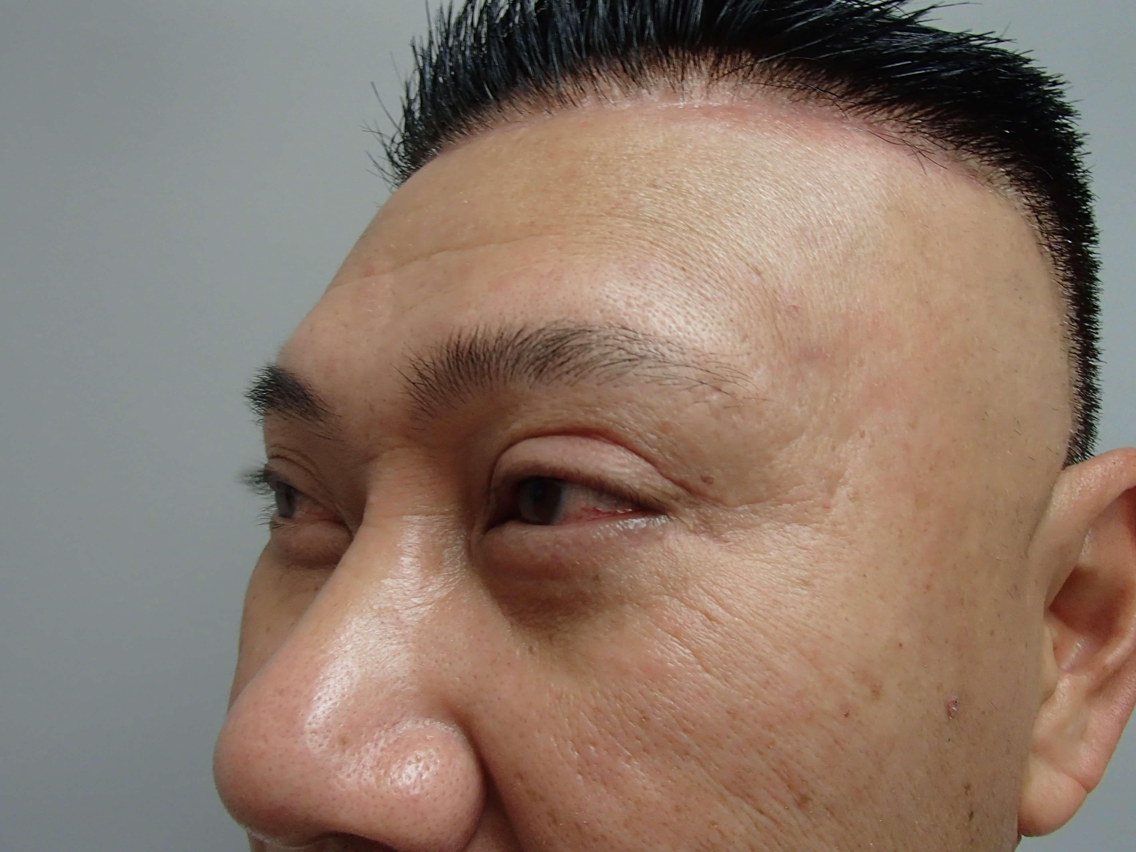 Blepharoplasty w/ Browlift After